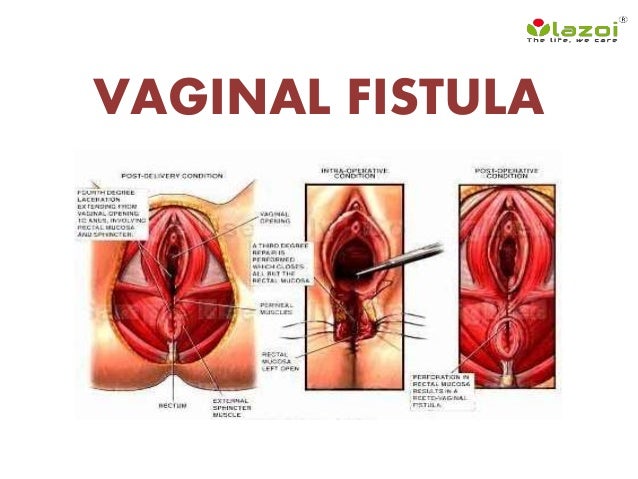 what are vaginal fistulas Man takes dildo in the ass